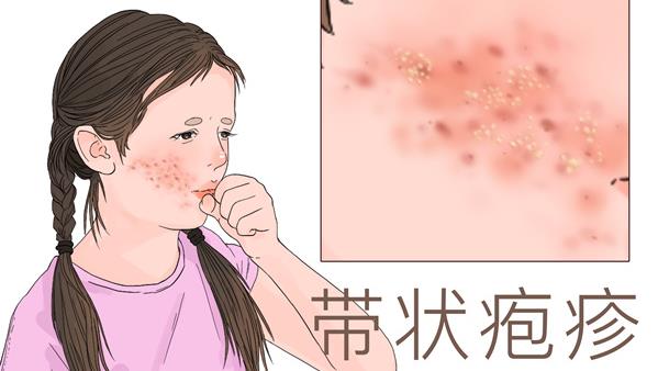 带状疱疹症状表现图片
