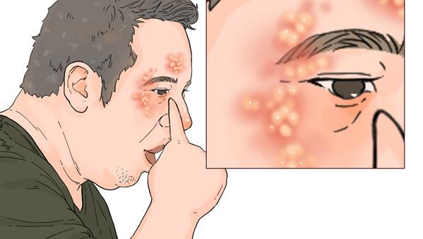 带状疱疹水疱特写图