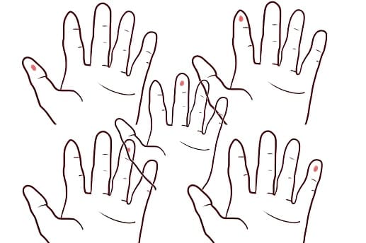 不同手指上的痣位置示意