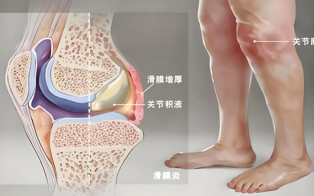 滑膜炎的症状图示
