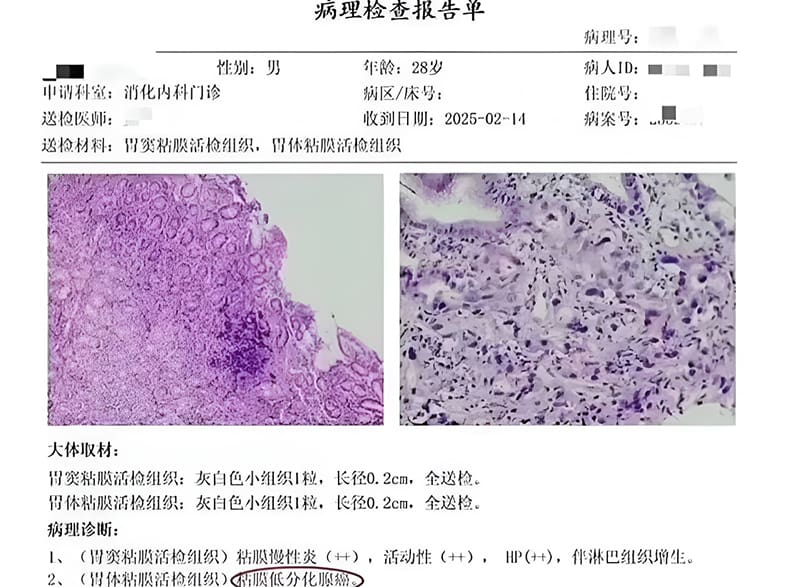 28岁小伙因熬夜导致胃癌，医生提醒熬夜的危害