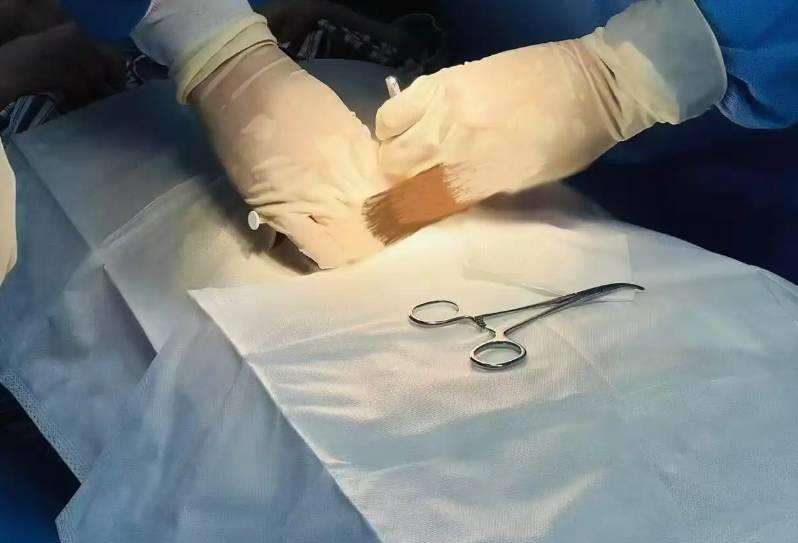 戒酒芯片微创植入,手术简单迅速