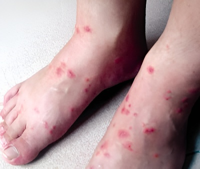 火蚁叮咬皮肤出现脓疱