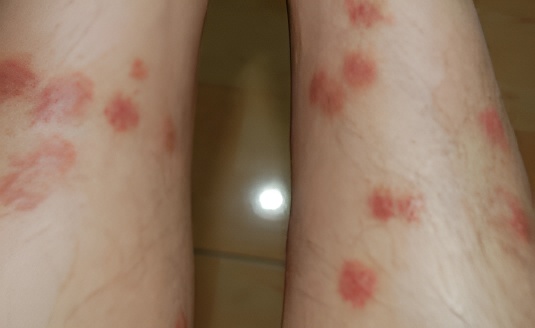 跳蚤叮咬后红疹呈直线排列