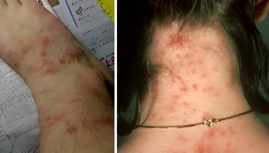 虱子咬后皮肤出现小红点