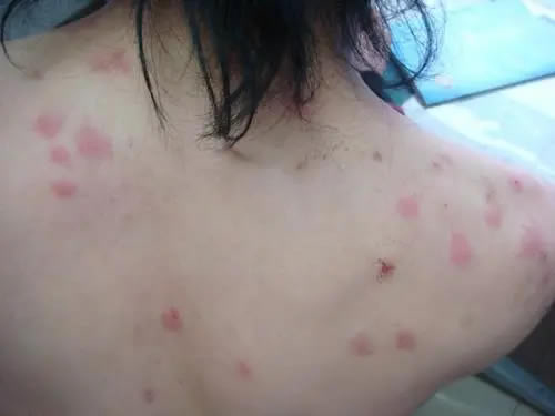 螨虫叮咬后皮肤出现丘疹瘙痒