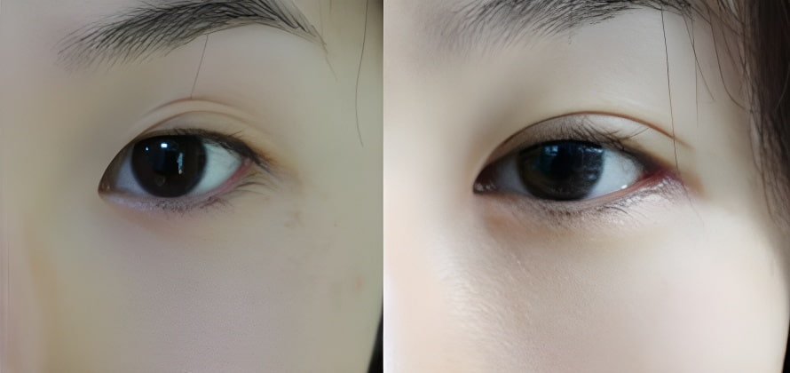 埋线双眼皮手术效果对比图