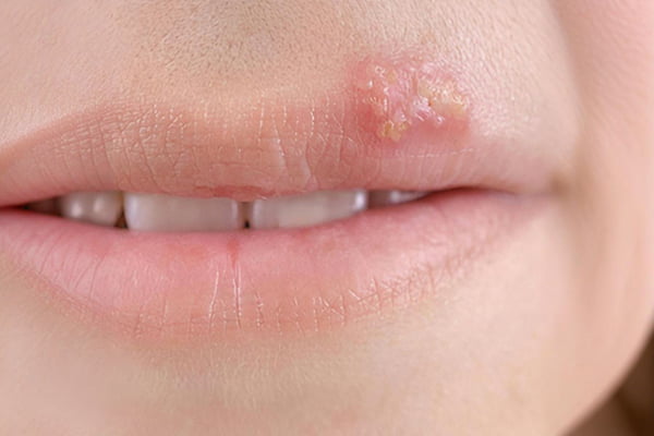 嘴唇疱疹症状示意图