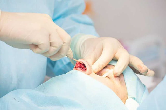 鼻整形手术示意图