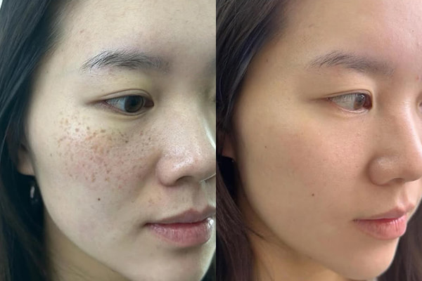 女性面部雀斑前后对比效果