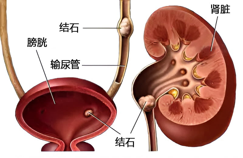 肾结石与泌尿系统示意图