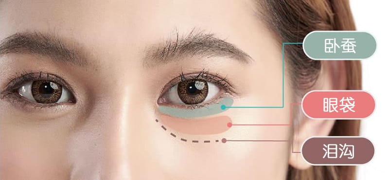 眼袋、卧蚕、泪沟示意图