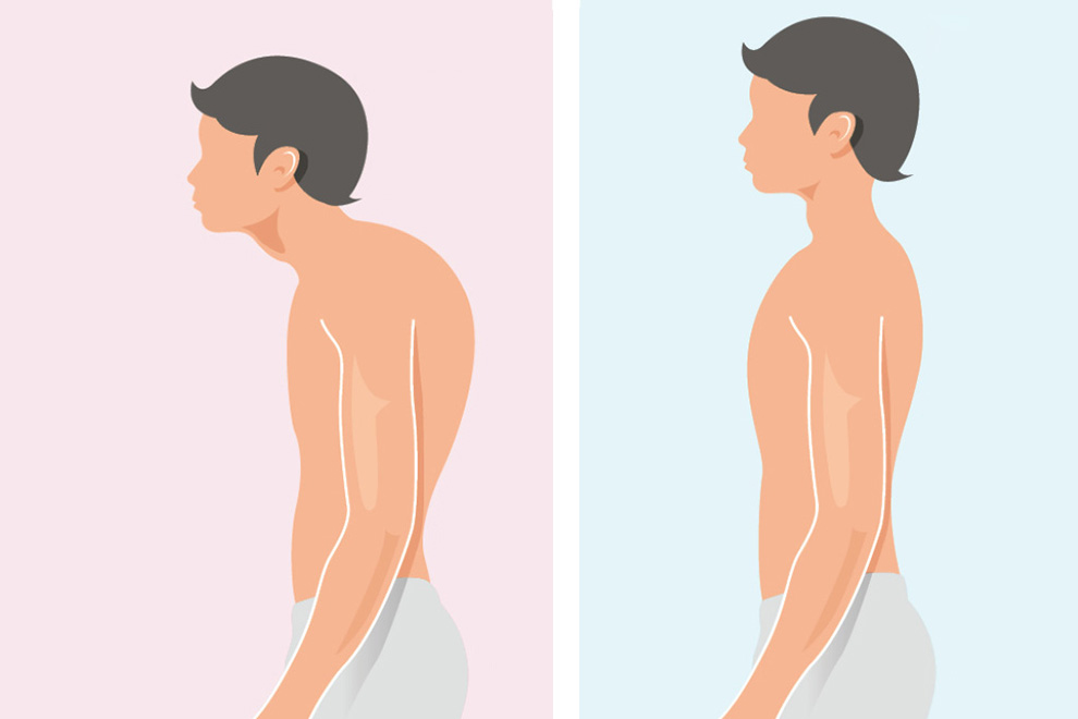 青少年驼背类型姿势对比图